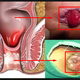 Illustration for article titled Penyakit Wasir Ke Dokter Apaem/em